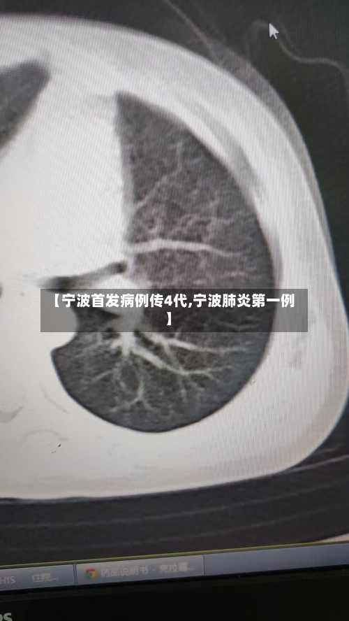 【宁波首发病例传4代,宁波肺炎第一例】-第2张图片